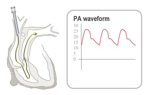 Insertion of the pulmonary artery catheter | Deranged Physiology