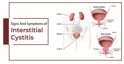 Interstitial Cystitis Sign & Symptoms, Causes, Treatments