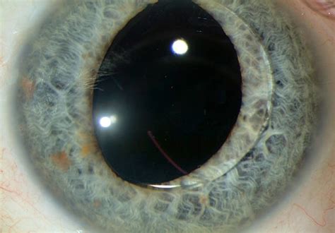 Incidence of pseudophakic intraocular lens exchange increases with ...