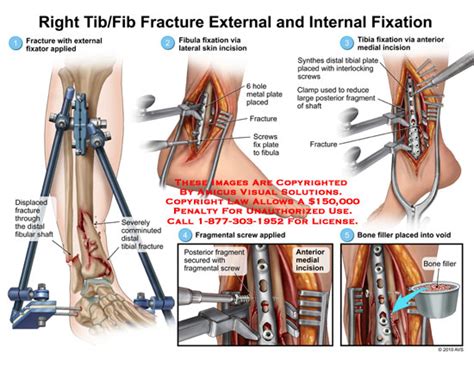 Tibia and fibula surgery - dynamicHop