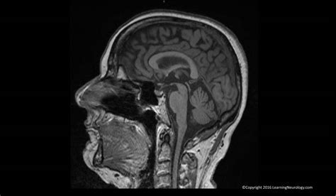 Approach to MRI brain | LearningNeurology.com