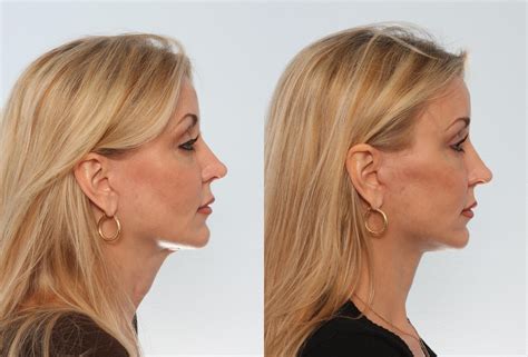 Before-After Neck Lift | Cape Town - Dr Gideon Maresky