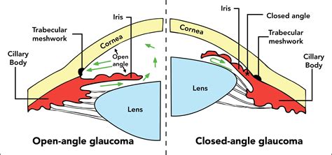 Best Glaucoma Specialist in Gurgaon | Glaucoma Surgery Doctor – Dr ...