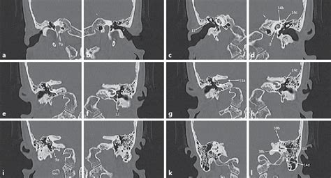 Figure 1 from Eight Items to Check on a Temporal Bone CT-Scan ...