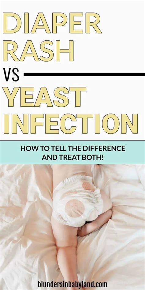 Diaper Rash vs Yeast Infection: How to Tell the Difference & Treat Both ...