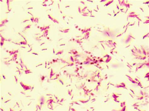 Mycobacterium kansasii Infection - StatPearls - NCBI Bookshelf