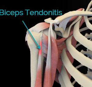 Biceps Tendonitis Cincinnati | Shoulder Pain Treatment West Chester ...