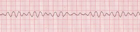 Rhythms, pacemakers, drugs at Galen College of Nursing - StudyBlue