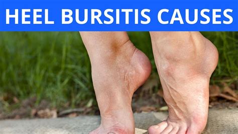 Heel Bursitis Causes - YouTube