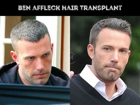 Kevin Costner Hair Transplant - Hair Loss & Technical Analysis