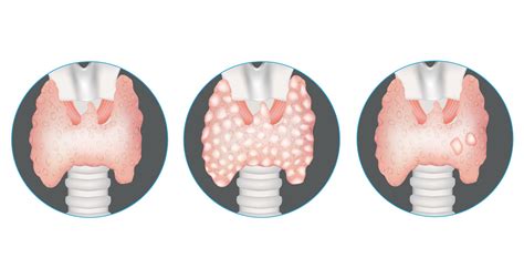 Thyroid Nodules Explained