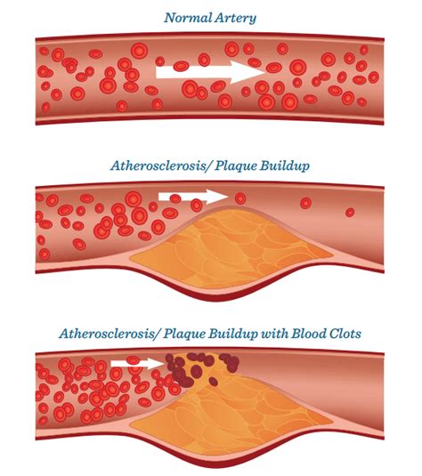 Atherosclerosis - The Heart Foundation