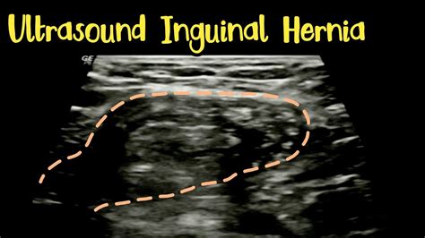 Inguinal Hernia - Ultrasound - YouTube