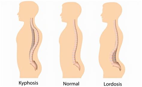 Achondroplasia | Causes, Signs, Standard Therapies, Prevention in ...