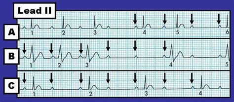 ECG Interpretation: ECG Interpretation Review #19 (2-to-1 AV Block ...