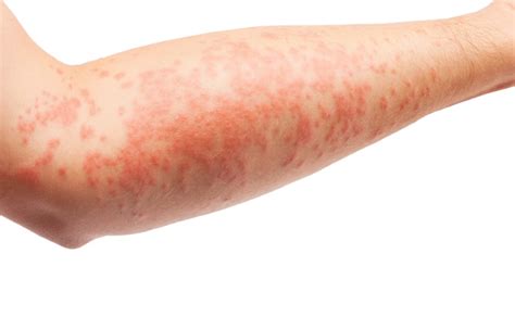 Eczema PNG Transparent Eczema.PNG Images. | PlusPNG