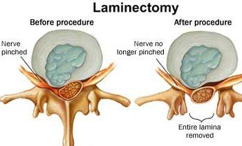 Minimally Invasive Procedures to Treat Foraminal Stenosis - MSI