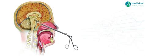 Prolactinoma: Symptoms, Causes and Treatment – Healthsoul