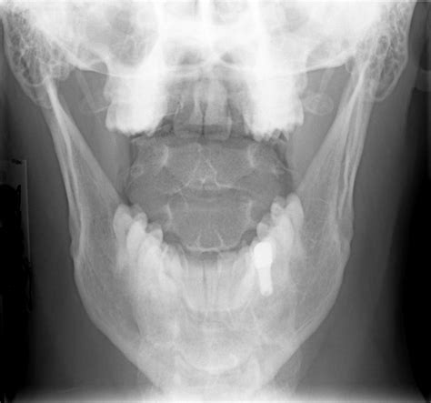 Dens Fracture Treatment | Dens Bone Fracture Surgery