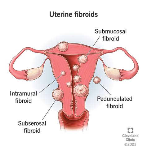 Fibroid uterus