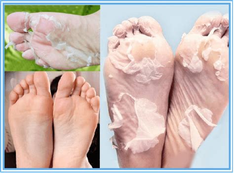 How to Remove Calluses from Feet: Guide for Smooth Skin