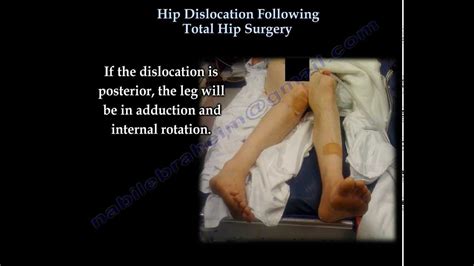 dislocation following total hip replacement causes and cures ...