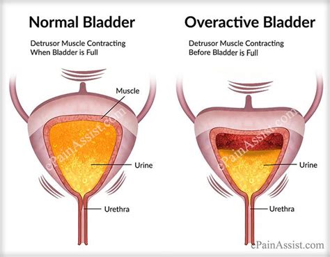 Pin on Overactive Bladder