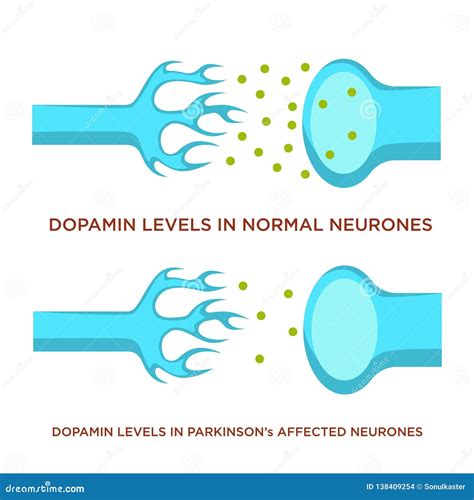 Dopamine Levels In A Normal And A Parkinsons Affected Neuron Vector ...