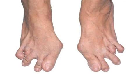 How rheumatoid arthritis affects the foot and ankle - Read Health ...