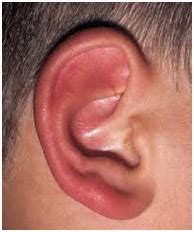 Outer Ear & Diseases Related To It - Denoc