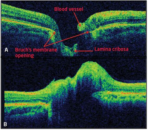 Oct Optic Nerve Head Glaucoma Astigmatism Glaucoma | Free Nude Porn Photos