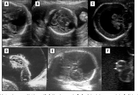 [PDF] Ultrasound in Trisomy 18 and 13 | Semantic Scholar