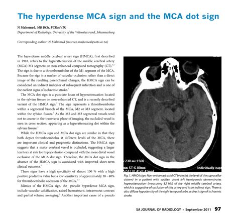 (PDF) The hyperdense MCA sign and the MCA dot sign