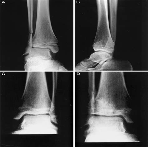 A New Type of Triplane Fracture in a 19-Year-Old Snowboarder : Journal ...