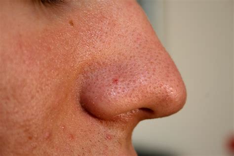 Файл:Nose with Blackhead 2009.jpg