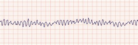 ECG INTERPRETATION FOR NCLEX: PART THREE - The Nurse Speak