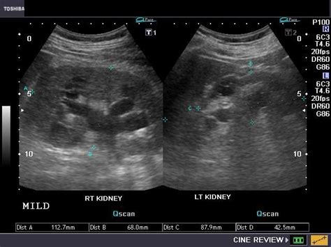 ON - RADIOLOGY: Grades of hydronephrosis (on Ultrasound imaging):