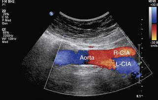 Ultrasound Assessment of Lower Extremity Arteries | Radiology Key