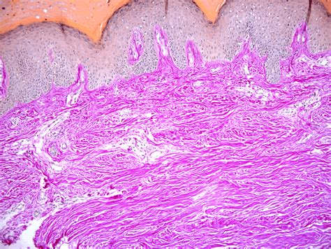 Thick dermis, papillary layer reduction and diffuse collagenization ...