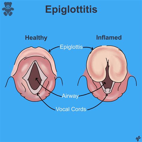 Swollen Epiglottis Treatment