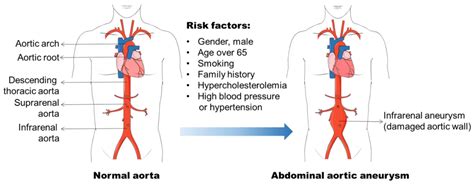 Thoracic Aortic Aneurysm Classification