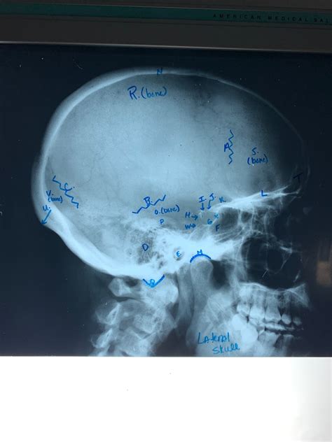 Lateral Skull radiograph Diagram | Quizlet