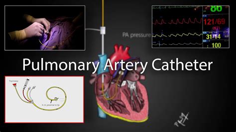 Pulmonary artery catheter (Swan-Ganz Catheter) placement and physiology ...