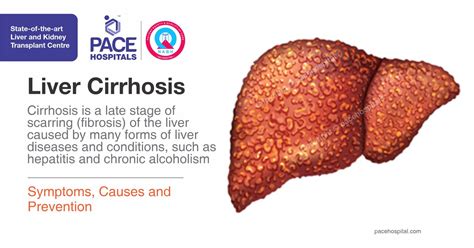 Liver Cirrhosis - Symptoms, Causes and Prevention