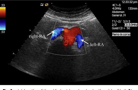 Figure 2 from Doppler ultrasound and renal artery stenosis: An overview ...