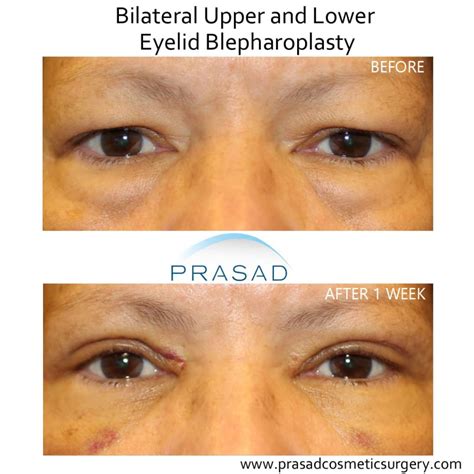 Eye Bag Surgery / Lower Blepharoplasty Recovery Process