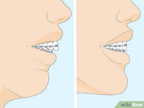 7 Ways to Fix an Overbite - wikiHow