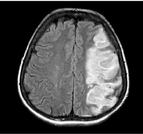 Ischemic stroke in the middle cerebral artery territory (magnetic ...