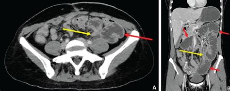 Ct Scan Whole Abdomen With Contrast Price - Captions Profile