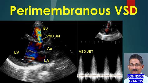 Perimembranous VSD - YouTube